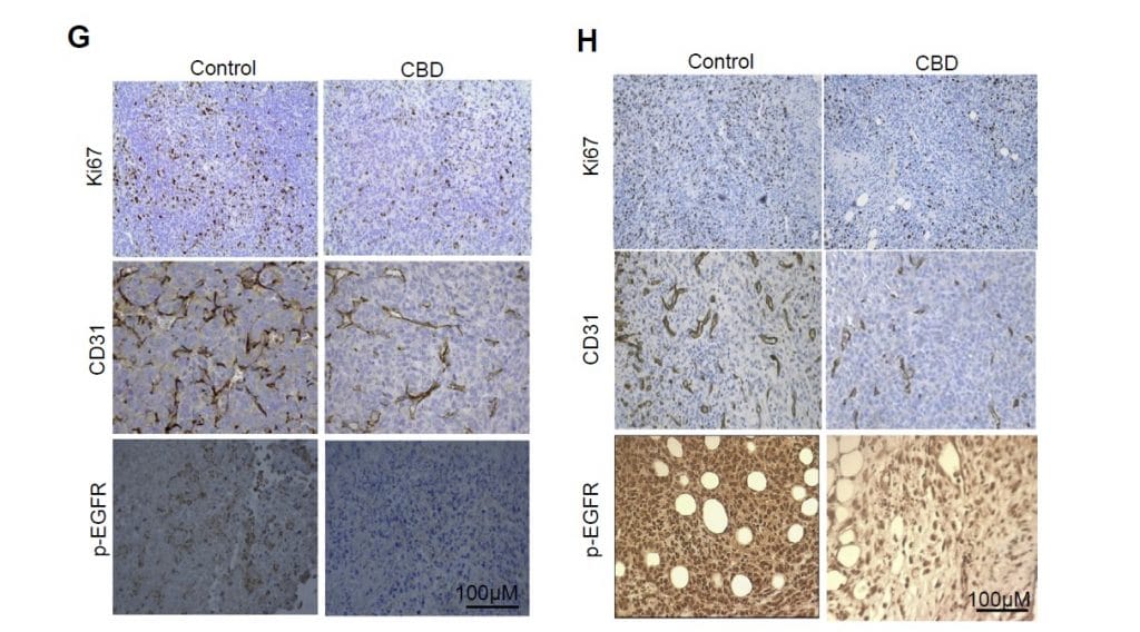 OverTure+/CBD作用於癌細胞的變化